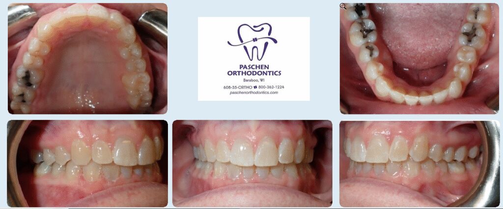 Smile transformation - Orthodontic solutions in Baraboo, WI