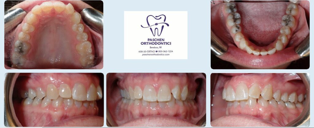 Smile transformation - Orthodontic solutions in Baraboo, WI