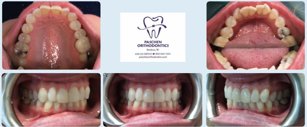 Smile transformation - Orthodontic solutions in Baraboo, WI