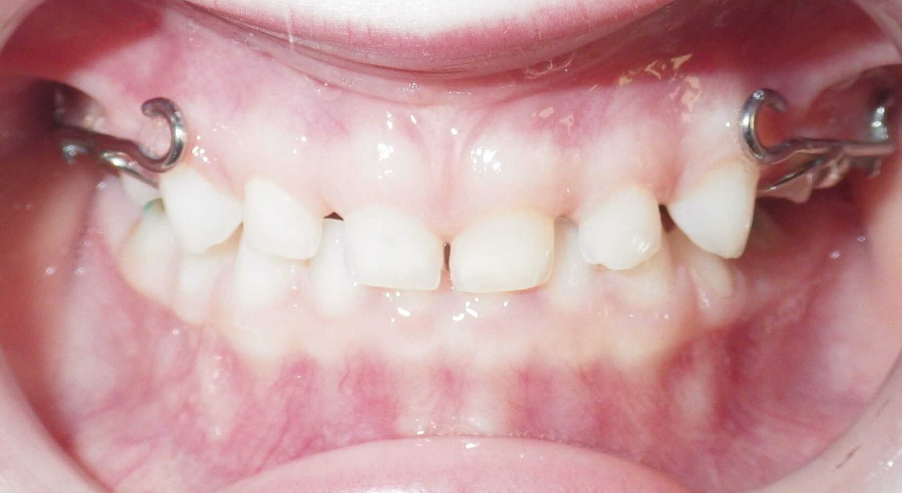 R.S.AFTER Smile transformation - Orthodontic solutions in Baraboo, WI