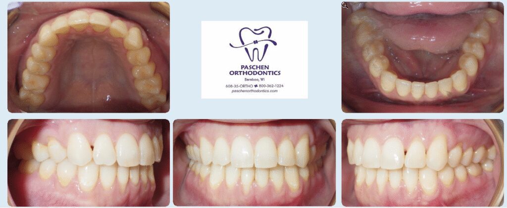 Smile transformation - Orthodontic solutions in Baraboo, WI